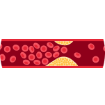 Enfermedades cardiovasculares